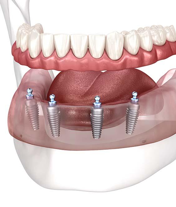 implant Denture